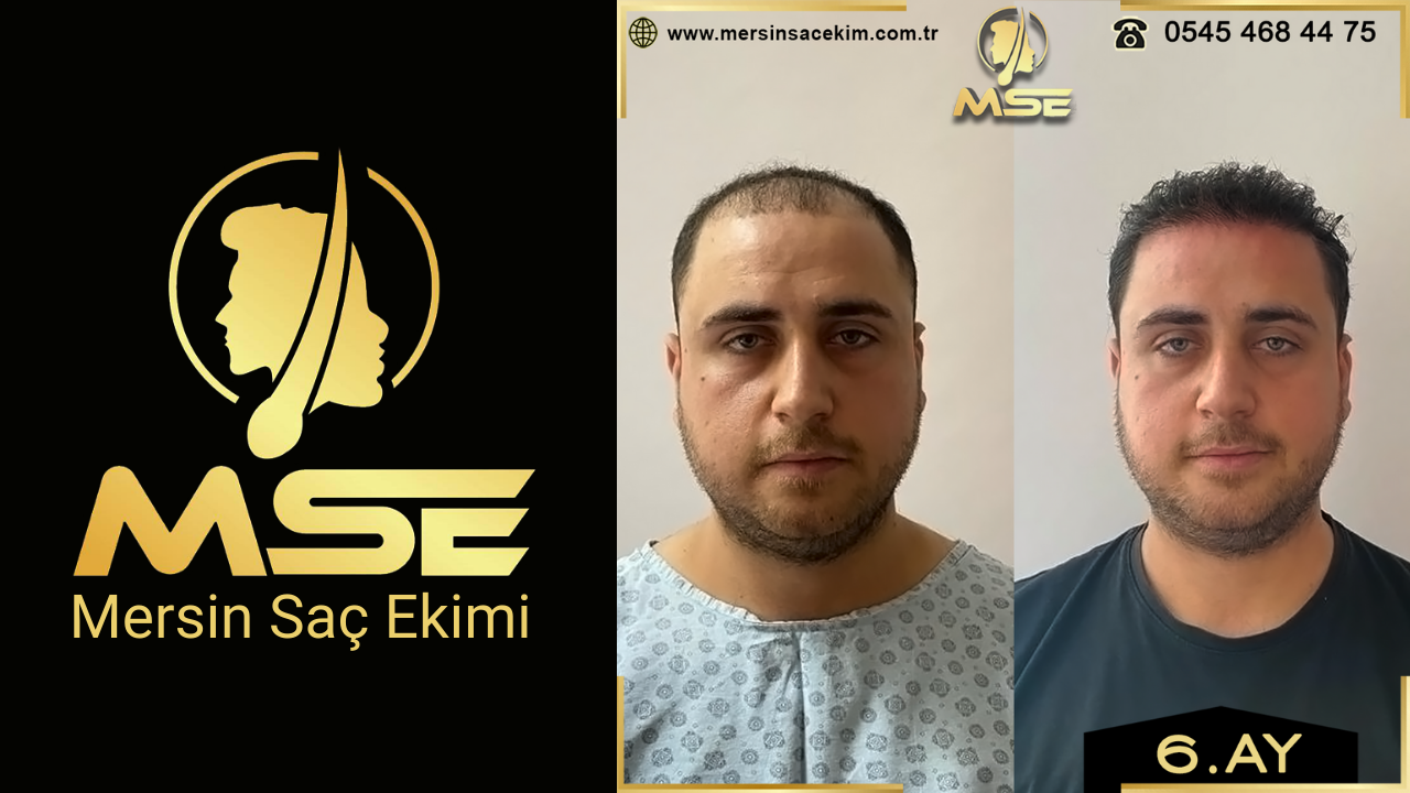 Mersin Saç Ekimi
